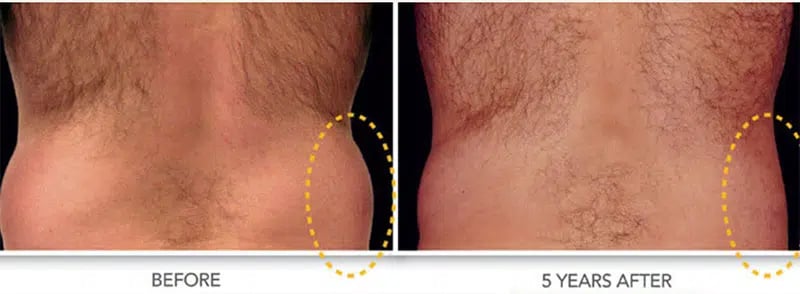 CoolSculpting before and after photo by Medispa Maui and Wellness Center in Kihei, HI