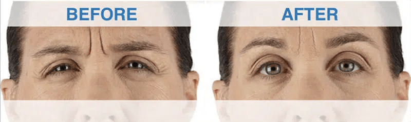 Xeomin before and after photo by medispa maui and wellness center in kihei hi