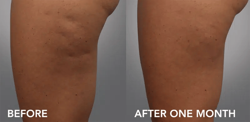 Cellfina before and after photo by Medispa Maui and Wellness Center in Kihei, HI