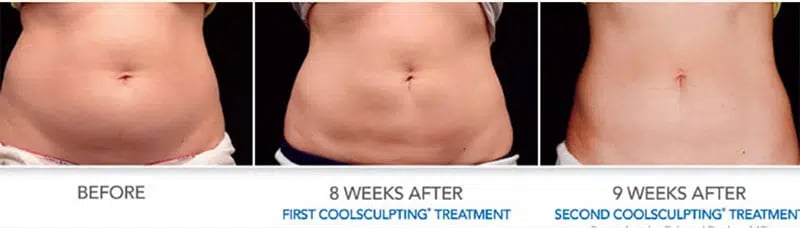 CoolSculpting before and after photo by Medispa Maui and Wellness Center in Kihei, HI