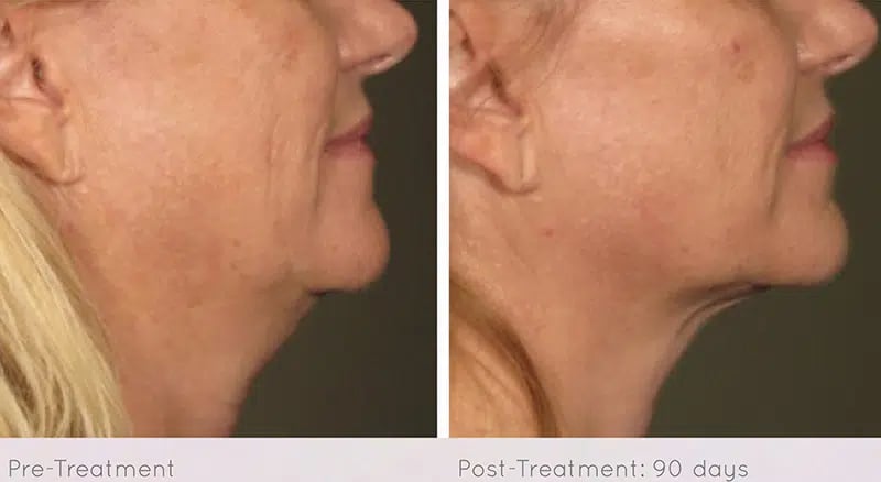 Ultherapy before and after photo by Medispa Maui and Wellness Center in Kihei, HI