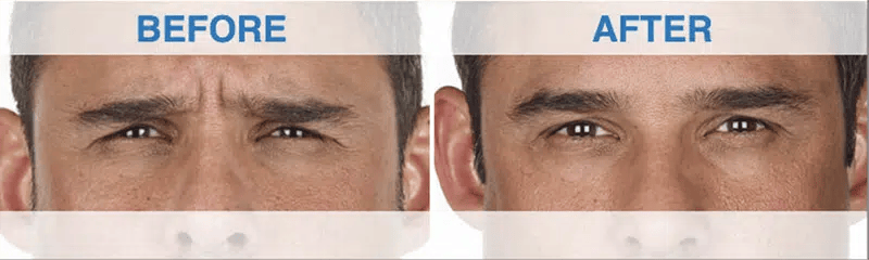 Xeomin before and after photo by medispa maui and wellness center in kihei hi