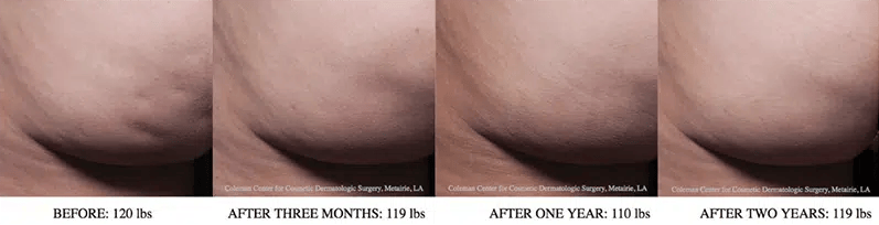 Cellfina before and after photo by Medispa Maui and Wellness Center in Kihei, HI