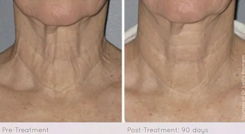 Ultherapy before and after photo by Medispa Maui and Wellness Center in Kihei, HI