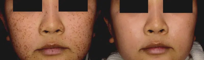 PicoSure before and after photo by Medispa Maui and Wellness Center in Kihei, HI