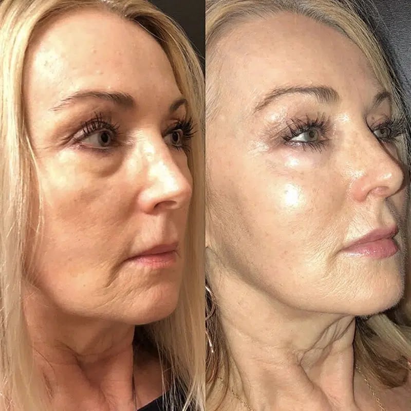 Liquid Lift Special before and after photo by Medispa Maui and Wellness Center in Kihei, HI