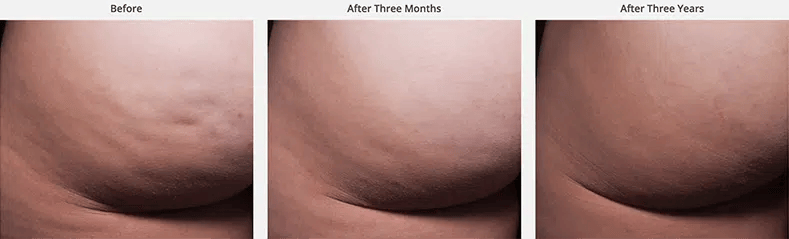 Cellfina before and after photo by Medispa Maui and Wellness Center in Kihei, HI