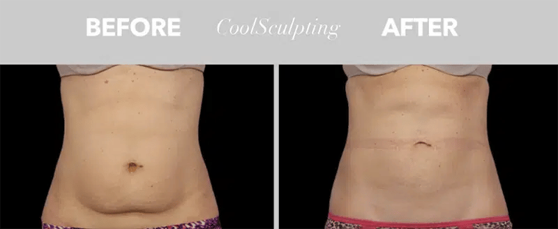 CoolSculpting before and after photo by Medispa Maui and Wellness Center in Kihei, HI