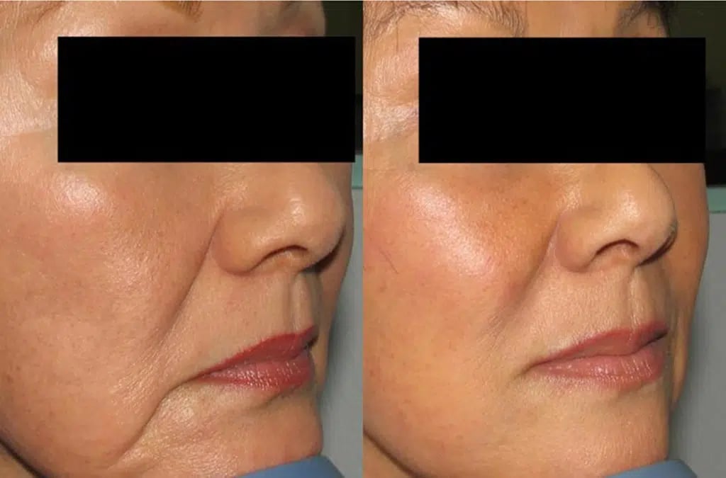 Fat grafting before and after photo by Medispa Maui and Wellness Center in Kihei, HI