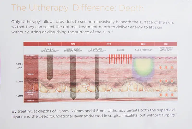 Infographics of Ultherapy difference