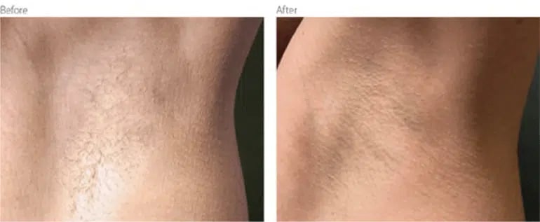 Laser hair removal before and after photo by Medispa Maui and Wellness Center in Kihei, HI