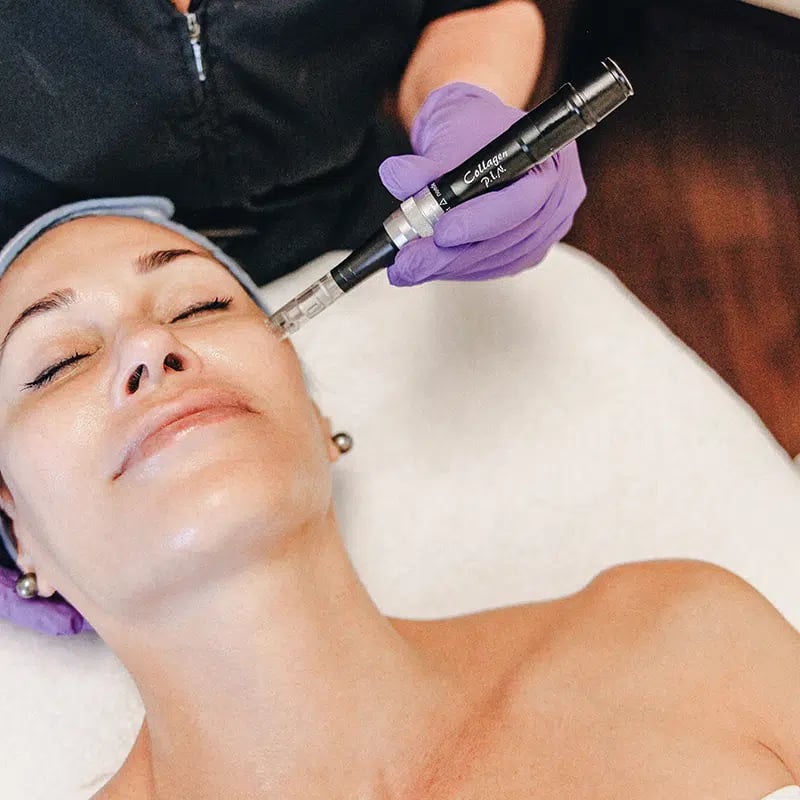 Microneedling services