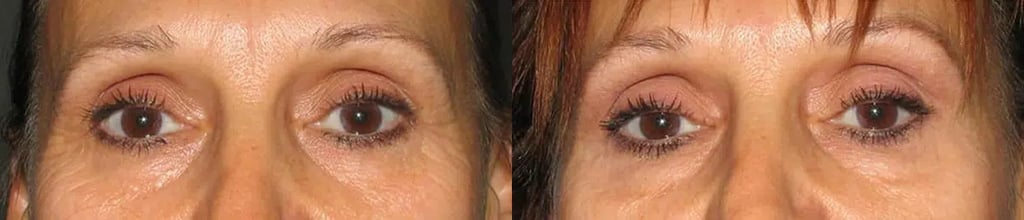 Botox before and after photo by Medispa Maui and Wellness Center in Kihei, HI