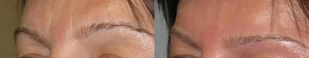 Botox before and after photo by Medispa Maui and Wellness Center in Kihei, HI