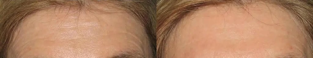Botox before and after photo by Medispa Maui and Wellness Center in Kihei, HI