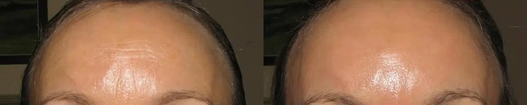 Botox before and after photo by Medispa Maui and Wellness Center in Kihei, HI