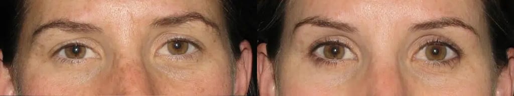 Botox before and after photo by Medispa Maui and Wellness Center in Kihei, HI