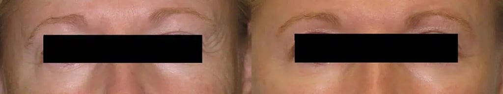 Botox before and after photo by Medispa Maui and Wellness Center in Kihei, HI
