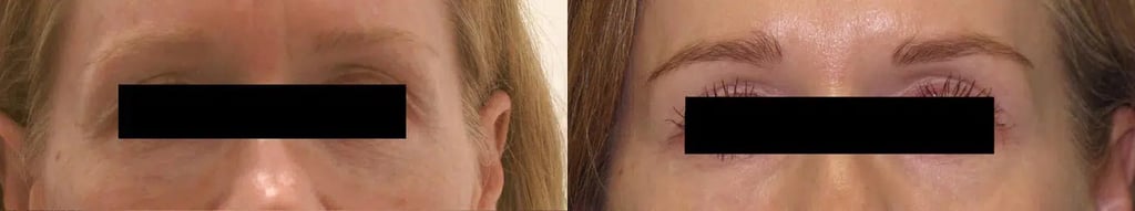 Total FX before and after photo by Medispa Maui and Wellness Center in Kihei, HI