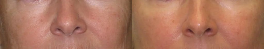 Palomar 1540 before and after photo by Medispa Maui and Wellness Center in Kihei, HI