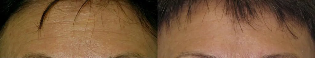 Palomar 1540 before and after photo by Medispa Maui and Wellness Center in Kihei, HI