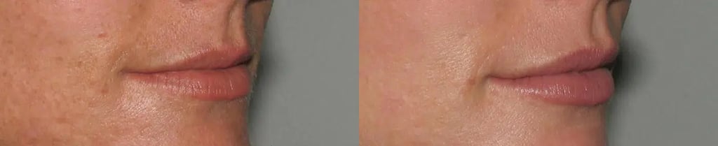 Dermal Fillers before and after photo by Medispa Maui and Wellness Center in Kihei, HI