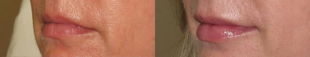 Dermal Fillers before and after photo by Medispa Maui and Wellness Center in Kihei, HI