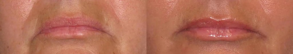 Dermal Fillers before and after photo by Medispa Maui and Wellness Center in Kihei, HI
