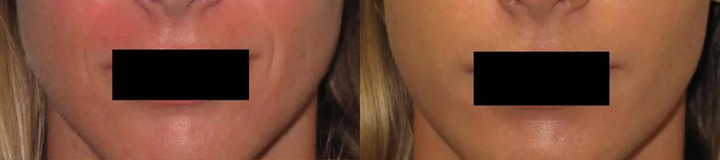 Dermal Fillers before and after photo by Medispa Maui and Wellness Center in Kihei, HI