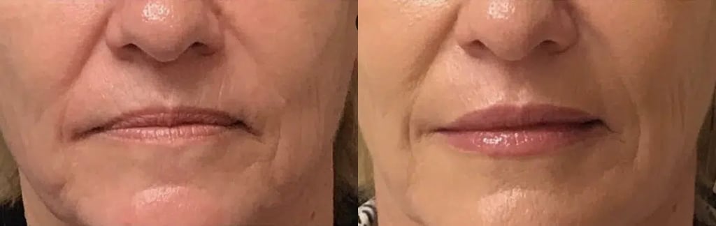 Dermal Fillers before and after photo by Medispa Maui and Wellness Center in Kihei, HI