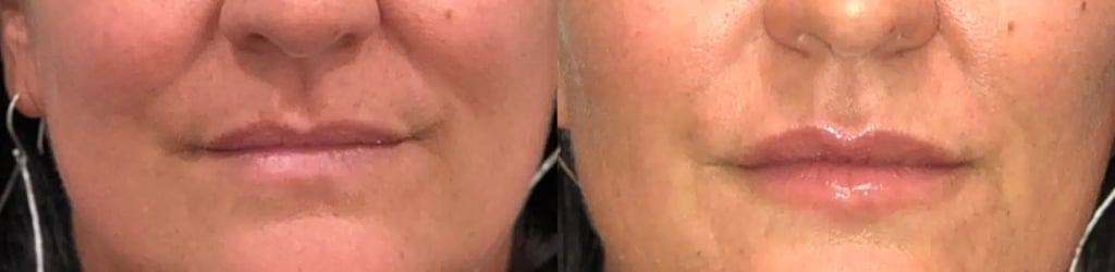 Dermal Fillers before and after photo by Medispa Maui and Wellness Center in Kihei, HI