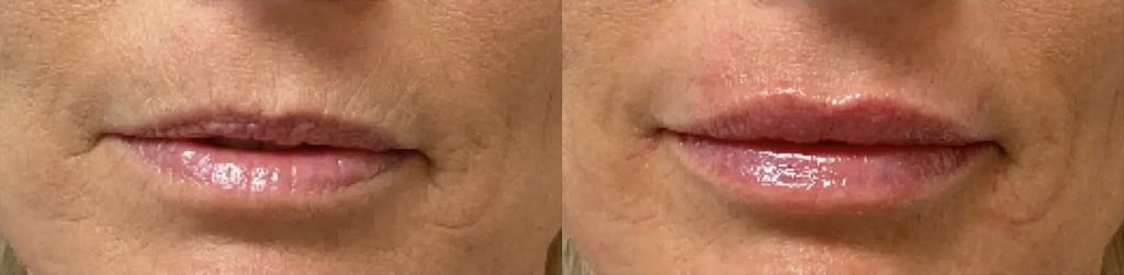 Dermal Fillers before and after photo by Medispa Maui and Wellness Center in Kihei, HI
