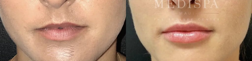 Dermal Fillers before and after photo by Medispa Maui and Wellness Center in Kihei, HI