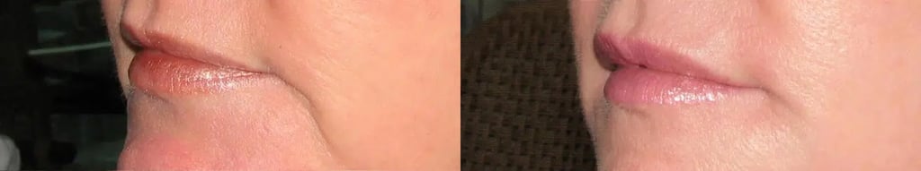 Dermal Fillers before and after photo by Medispa Maui and Wellness Center in Kihei, HI