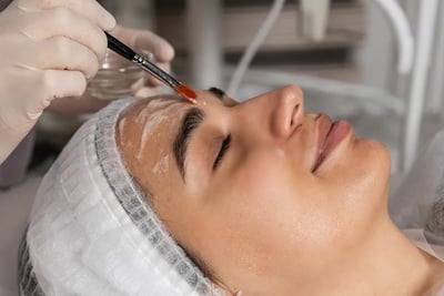 Customizing Chemical Peel Treatments for Different Skin Types