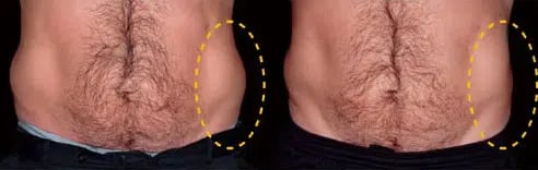 CoolSculpting before and after photo by Medispa Maui and Wellness Center in Kihei, HI CoolSculpting before and after photo by Medispa Maui and Wellness Center in Kihei, HI