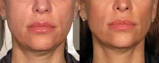 Ultherapy before and after photo by Medispa Maui and Wellness Center in Kihei, HI Ultherapy before and after photo by Medispa Maui and Wellness Center in Kihei, HI