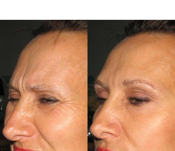 botox bna botox bna