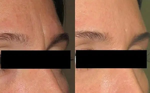 Botox before and after photo by Medispa Maui and Wellness Center in Kihei, HI