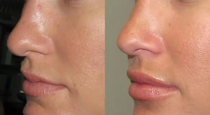 Dermal Fillers before and after photo by Medispa Maui and Wellness Center in Kihei, HI