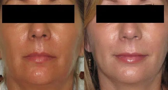 Dermal Fillers before and after photo by Medispa Maui and Wellness Center in Kihei, HI