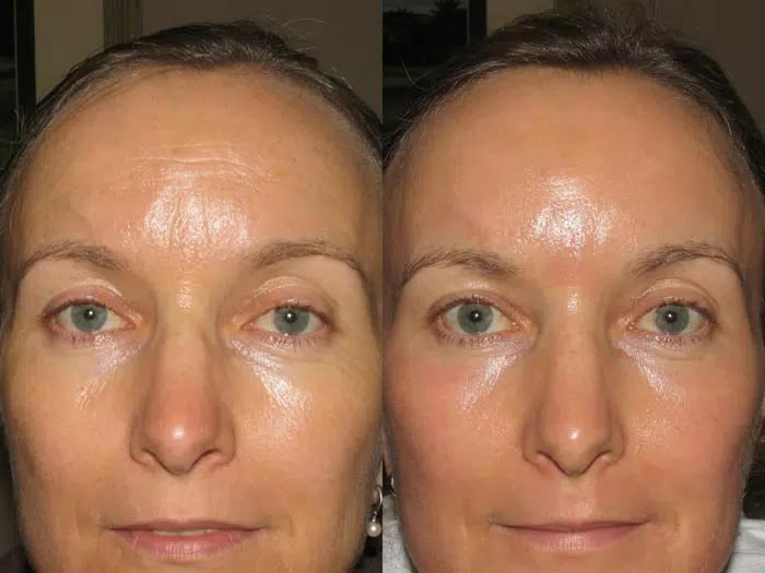Total FX before and after photo by Medispa Maui and Wellness Center in Kihei, HI Total FX before and after photo by Medispa Maui and Wellness Center in Kihei, HI