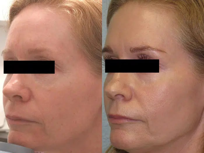 Total FX before and after photo by Medispa Maui and Wellness Center in Kihei, HI Total FX before and after photo by Medispa Maui and Wellness Center in Kihei, HI