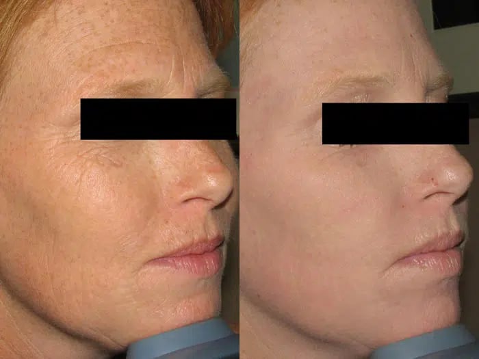 Total FX before and after photo by Medispa Maui and Wellness Center in Kihei, HI Total FX before and after photo by Medispa Maui and Wellness Center in Kihei, HI