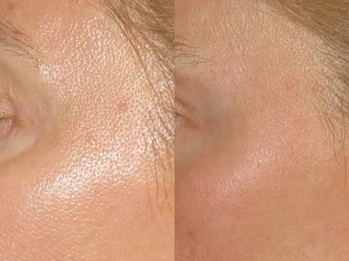 Total FX before and after photo by Medispa Maui and Wellness Center in Kihei, HI Total FX before and after photo by Medispa Maui and Wellness Center in Kihei, HI