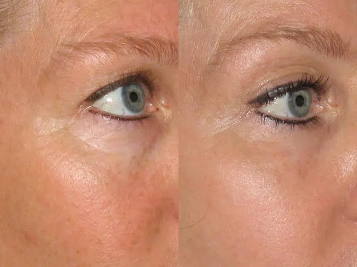 Total FX before and after photo by Medispa Maui and Wellness Center in Kihei, HI Total FX before and after photo by Medispa Maui and Wellness Center in Kihei, HI