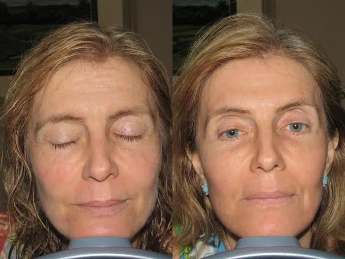 Total FX before and after photo by Medispa Maui and Wellness Center in Kihei, HI Total FX before and after photo by Medispa Maui and Wellness Center in Kihei, HI