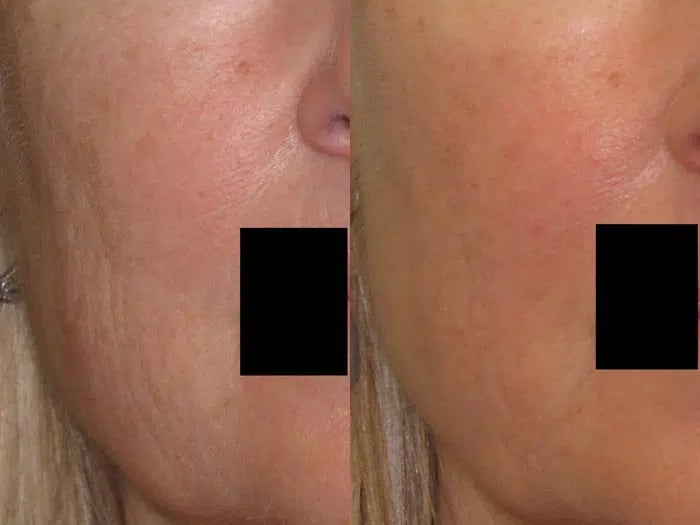 Palomar 1540 before and after photo by Medispa Maui and Wellness Center in Kihei, HI