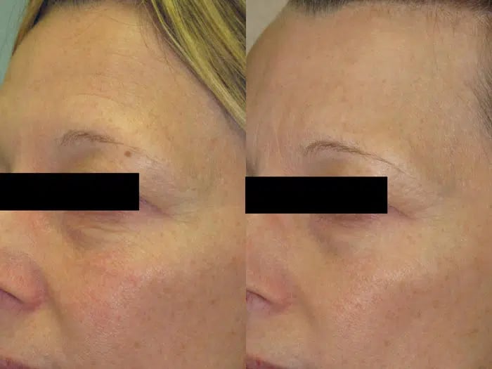Palomar 1540 before and after photo by Medispa Maui and Wellness Center in Kihei, HI
