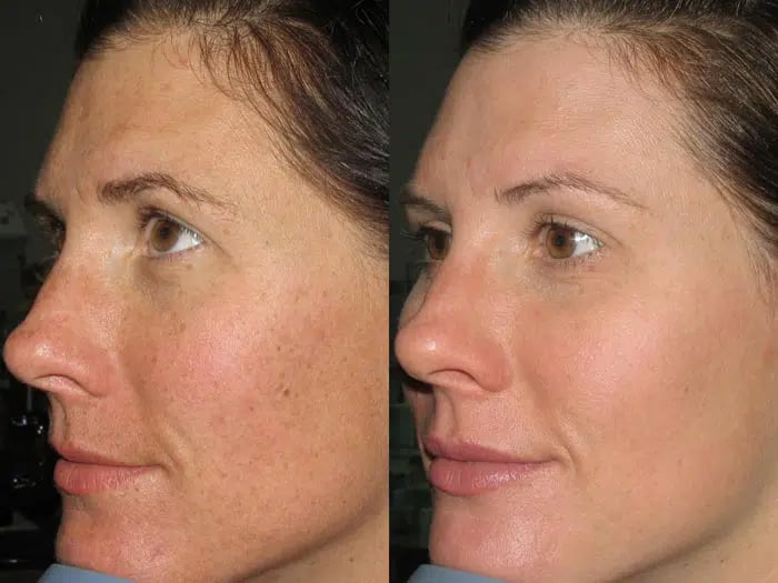 Photorejuvenation before and after photo by Medispa Maui and Wellness Center in Kihei, HI